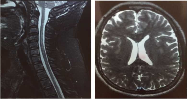 Магнитно резонансная томография (3,0 Тл) головного мозга с захватом спинного мозга (