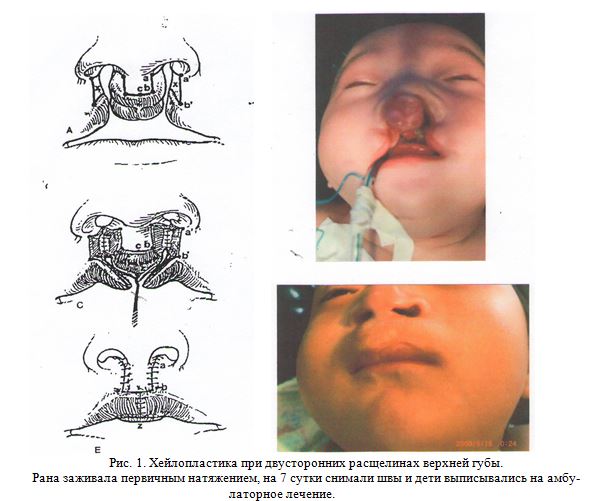 Хейлопластика при двусторонних расщелинах верхней губы. Рана заживала первичным натяжением, на 7 сутки снимали швы и дети выписывались на амбу-латорное лечение