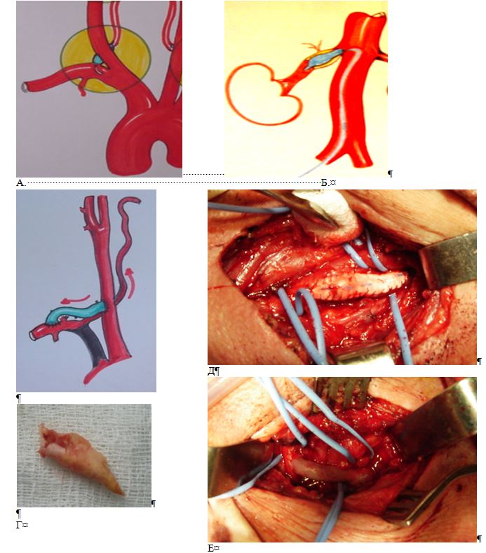 Окклюзия подключичной артерии фото