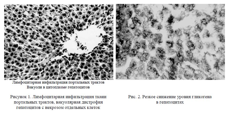 Лимфоцитарная инфильтрация ткани портальных трактов, вакуолярная дистрофия гепатоцитов с некрозом отдельных клеток