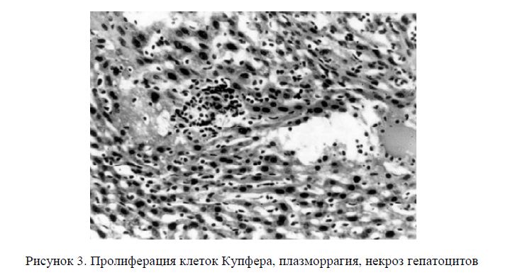 Пролиферация клеток Купфера, плазморрагия, некроз гепатоцитов