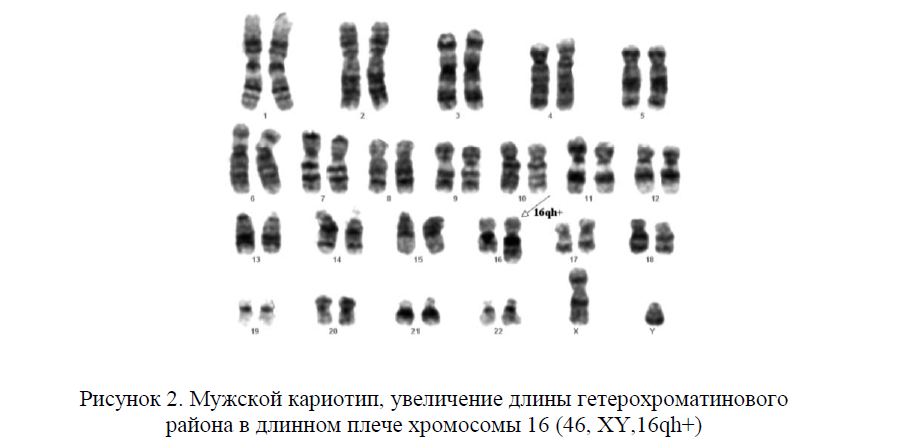 Мужской кариотип, увеличение длины гетерохроматинового района в длинном плече хромосомы 16 (46, ХY,16qh+)
