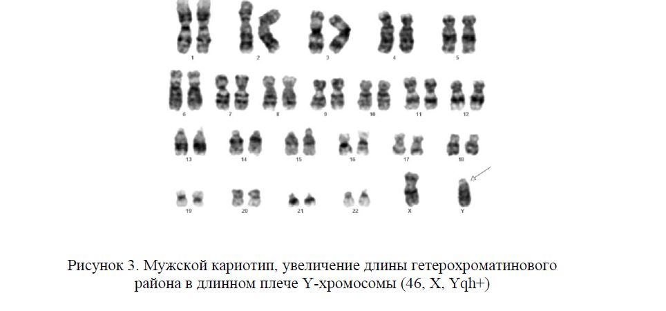 Мужской кариотип, увеличение длины гетерохроматинового района в длинном плече Y-хромосомы (46, Х, Yqh+)