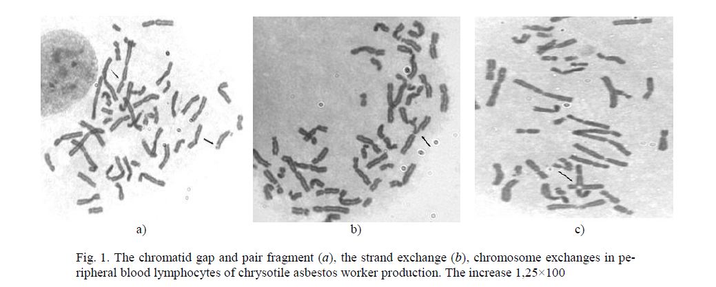 The chromatid gap and pair fragment (a), the strand exchange (b), chromosome exchanges in peripheral blood lymphocytes of chrysotile asbestos worker production. The increase 1,25×100 