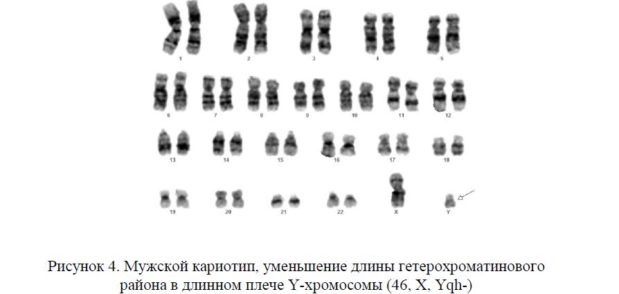 Мужской кариотип, уменьшение длины гетерохроматинового района в длинном плече Y-хромосомы (46, Х, Yqh-) 