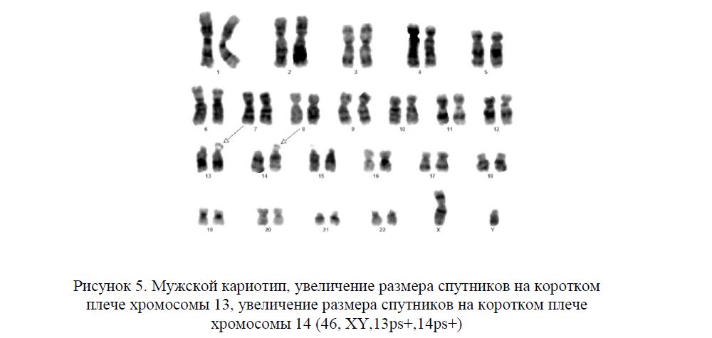 Мужской кариотип, увеличение размера спутников на коротком плече хромосомы 13, увеличение размера спутников на коротком плече хромосомы 14 (46, ХY,13ps+,14ps+)