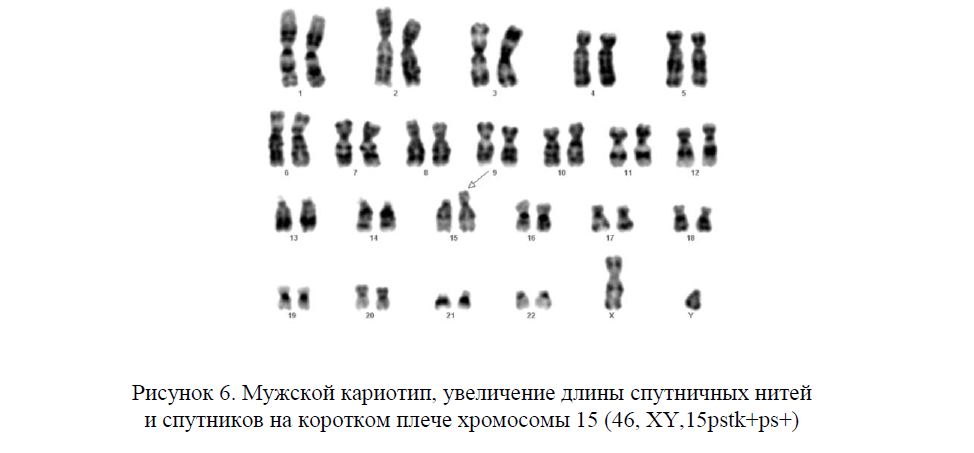 Мужской кариотип, увеличение длины спутничных нитей и спутников на коротком плече хромосомы 15 (46, ХY,15pstk+ps+) 