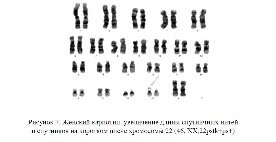 Женский кариотип, увеличение длины спутничных нитей и спутников на коротком плече хромосомы 22 (46, ХХ,22pstk+ps+) 