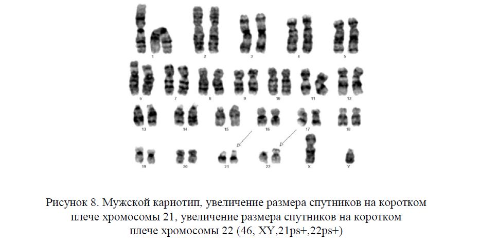 Мужской кариотип, увеличение размера спутников на коротком плече хромосомы 21, увеличение размера спутников на коротком плече хромосомы 22 (46, ХY,21ps+,22ps+)
