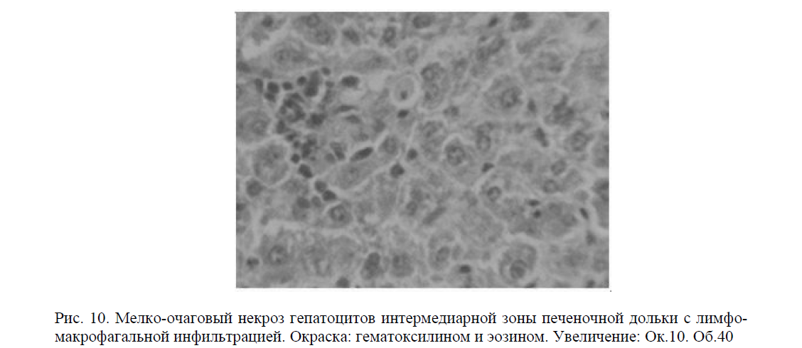 Мелко-очаговый некроз гепатоцитов интермедиарной зоны печеночной дольки с лимфомакрофагальной инфильтрацией. Окраска: гематоксилином и эозином. Увеличение: Ок.10. Об.40 