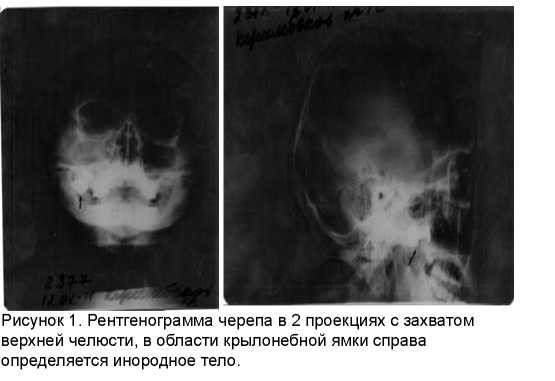 Сочетанная черепно-лицевая травма при огнестрельных ранениях