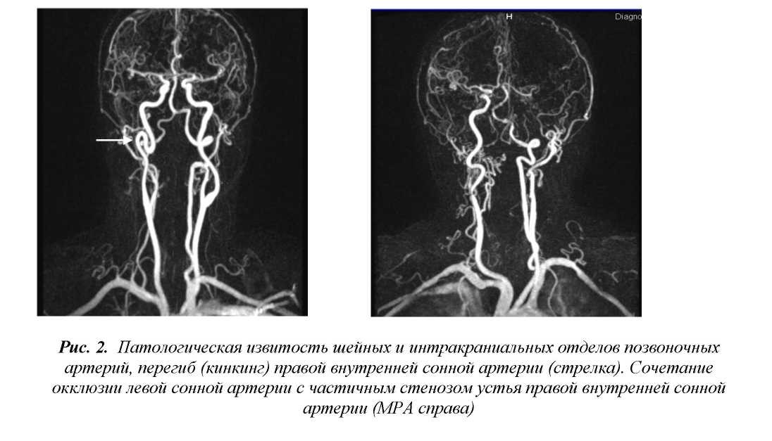 Сужение правой артерии. Гипоплазия правой позвоночной артерии на кт. Гипоплазия позвоночной артерии кт. Гипоплазия v4 позвоночной артерии. Гипоплазия правой позвоночной артерии норма.