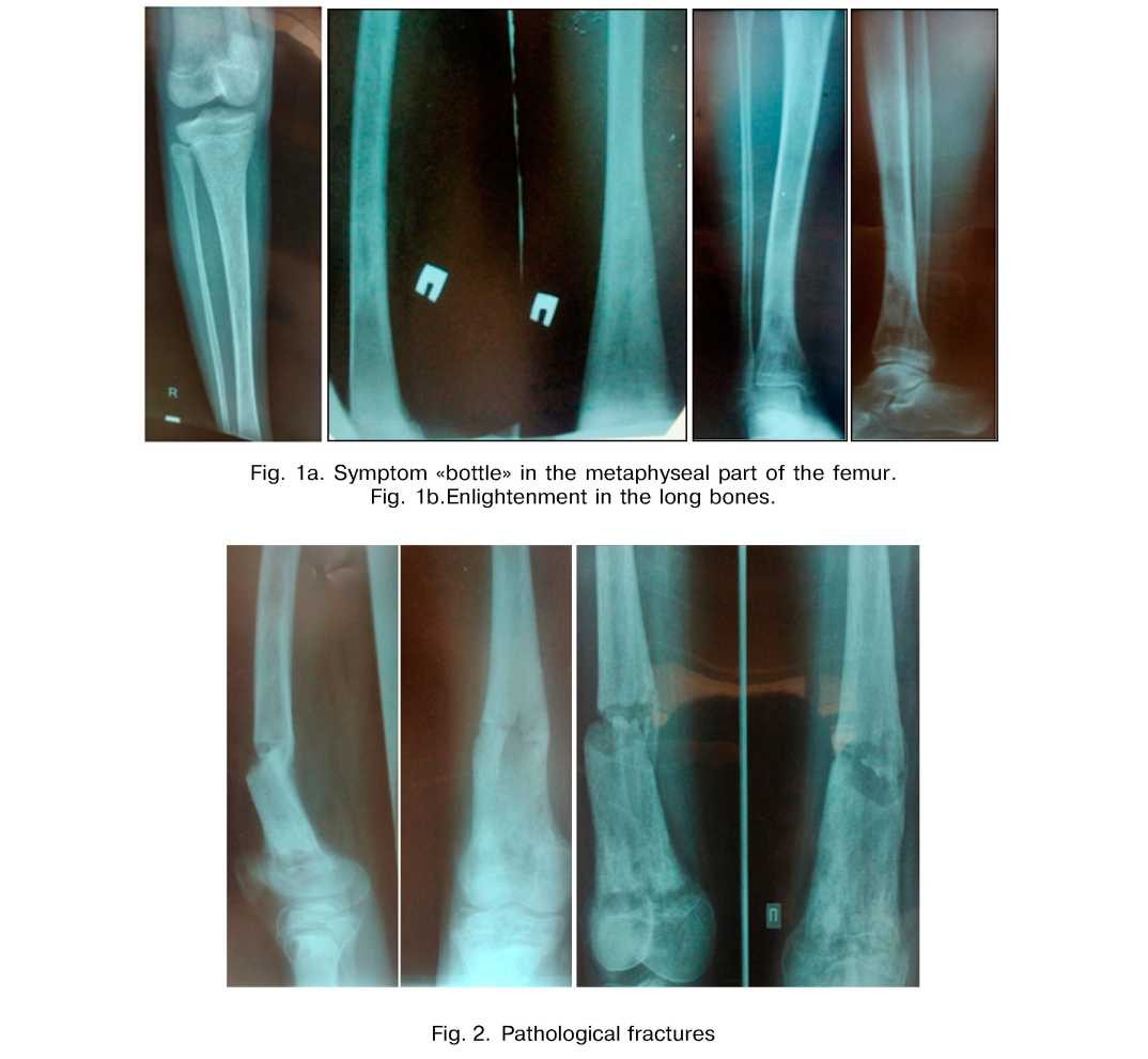 Municipal clinical hospital № 4 case from practice. radiological diagnosis of gaucher disease (clinical observation)