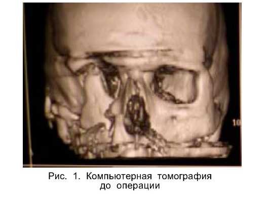 Сочетанные повреждения костей средней зоны лица c черепно-мозговой травмой:алгоритмы диагностики и лечения