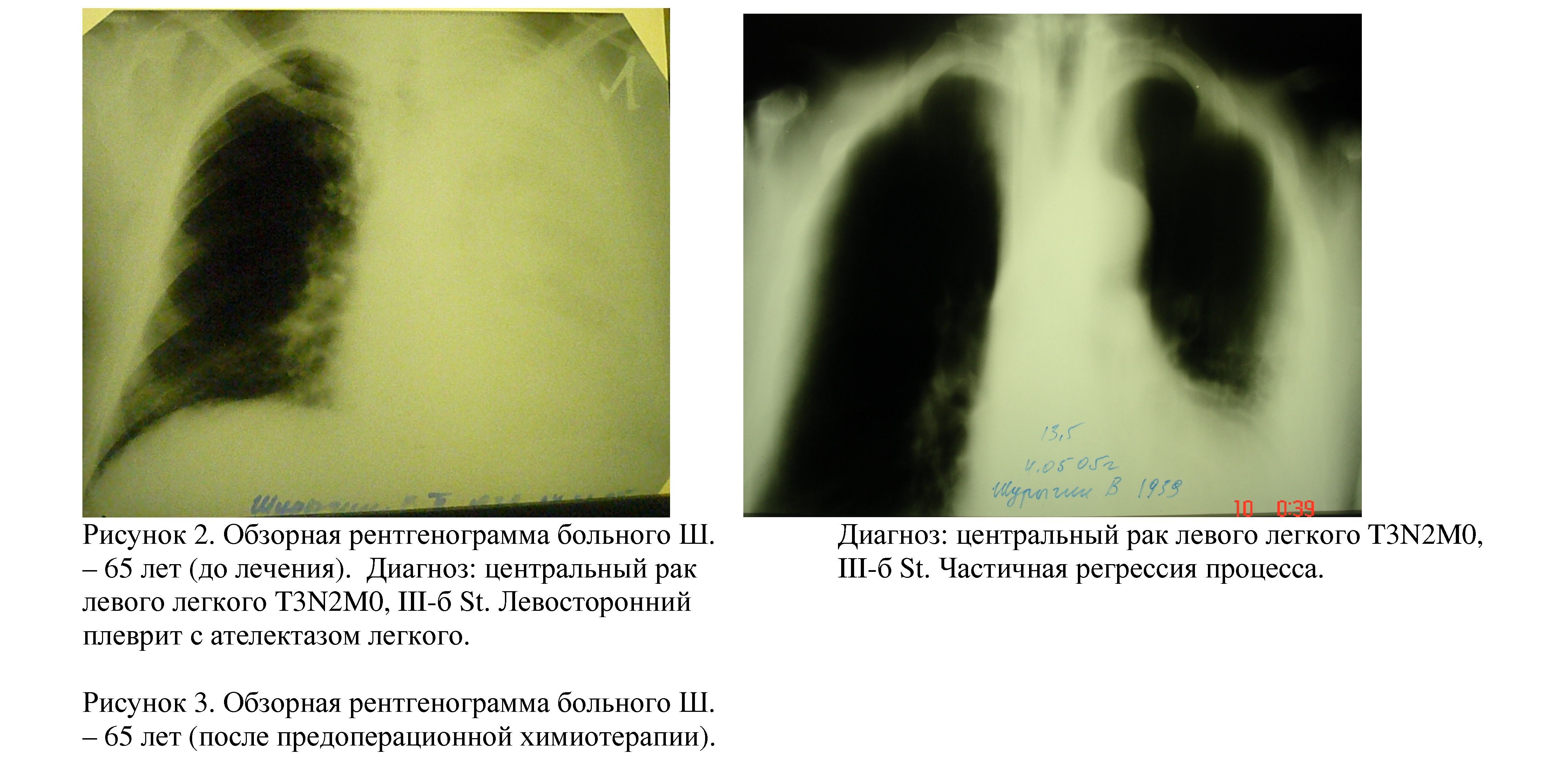 Результаты химиоинфузии в бронхиальную артерию в комплексном лечении .