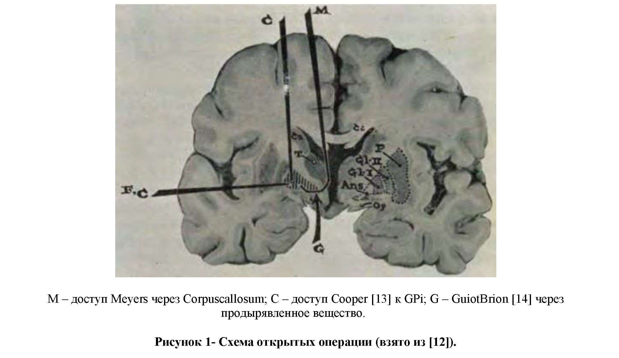 История нейрохирургического лечения болезни Паркинсона