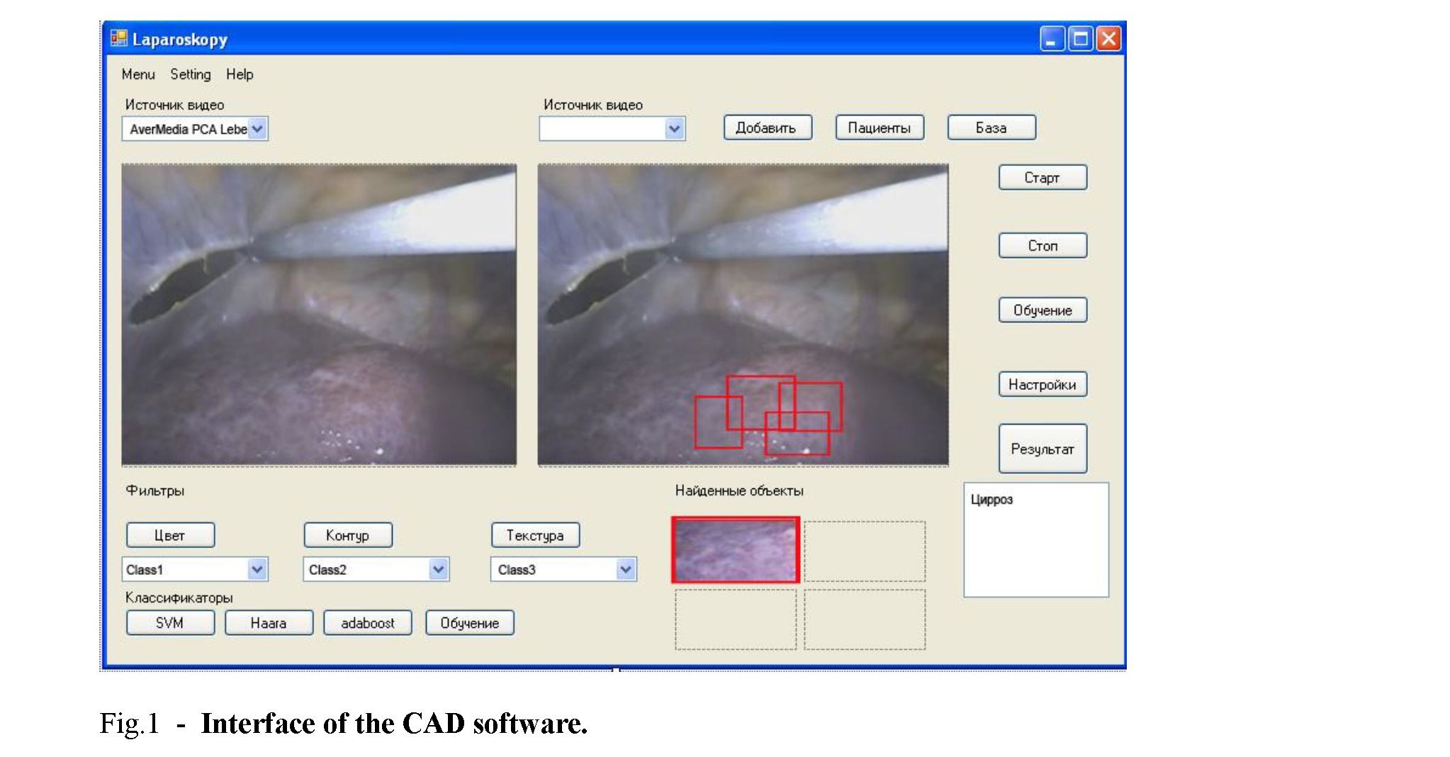 Computer automatic diagnostics (cad) of appenidicites based on classification of laparoscopic images