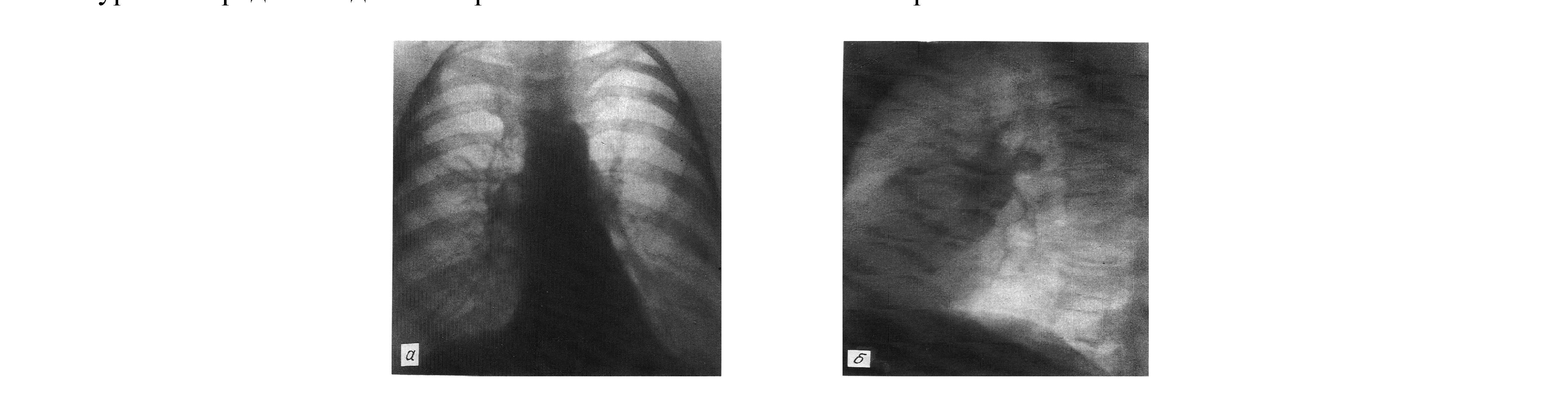 Рентгеноанатомические изменения в легких у больных хроническим обструктивным бронхитом и бронхиальной астмой в период обострения
