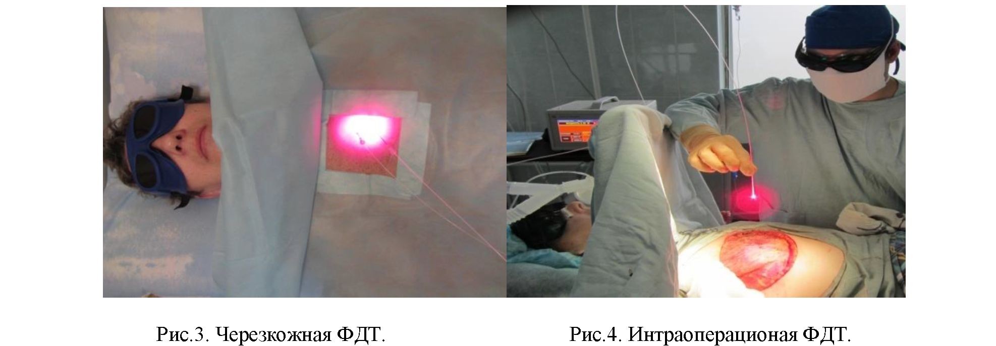 Возможности применения фотодинамической терапии у пациентов с местнораспространенным раком молочной железы