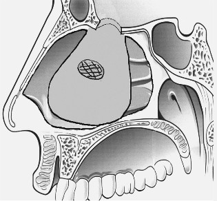 Схематическое изображение этапов закрытия дефектов основания черепа и твердой мозговой оболочки мукоперихондрально-периостальным лоскутом противоположной стороны