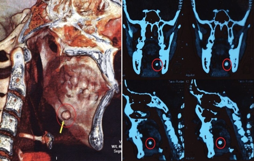 Мультиспиральные томограммы поднижнечелюстной слюнной железы слева пациента Т.Р., 28 лет.