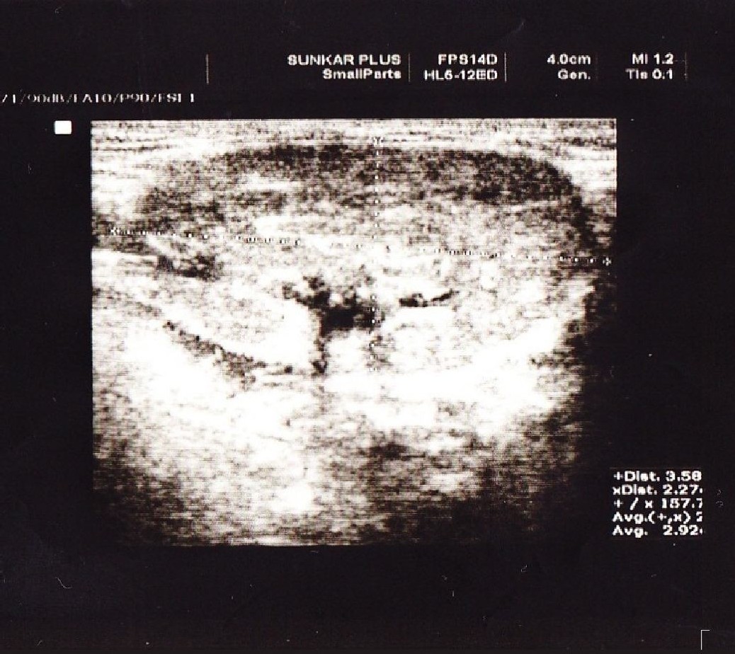 Эхограмма левой поднижнечелюстной слюнной железы пациента Т.Р., 28 лет.