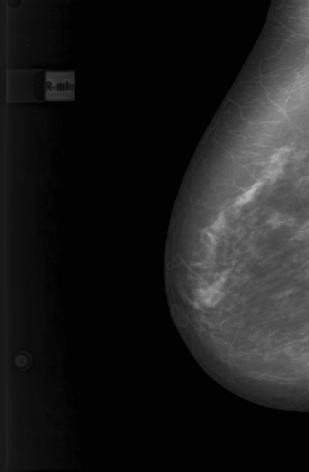Цифровые маммограммы пациентки И., 51 г. Рак левой молочной железы, верхне-наружная локализация