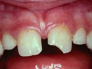 Перелом угла коронки зуба 2.1 у ребенка 7 лет