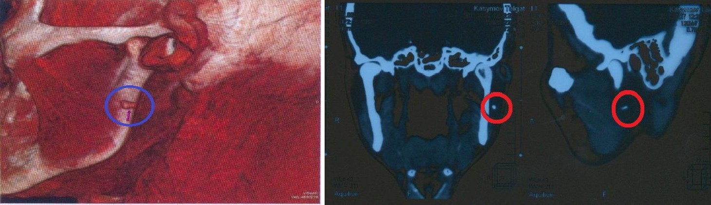 мультиспиральные томограммы околоушной слюнной железы слева пациента К.Т., 37 лет.