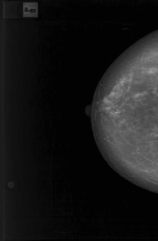Цифровые маммограммы пациентки И., 51 г. Рак левой молочной железы, верхне-наружная локализация