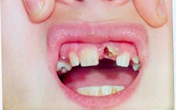 диагноз Перелом коронки зуба 2.1 по шейке у ребенка 8 лет