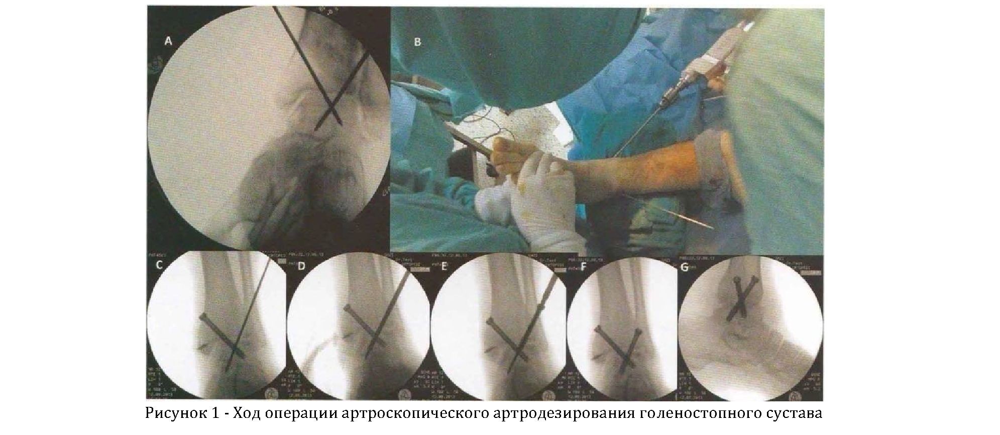 Артроскопическое артродезирование при дегенеративных заболеваниях голеностопного сустава