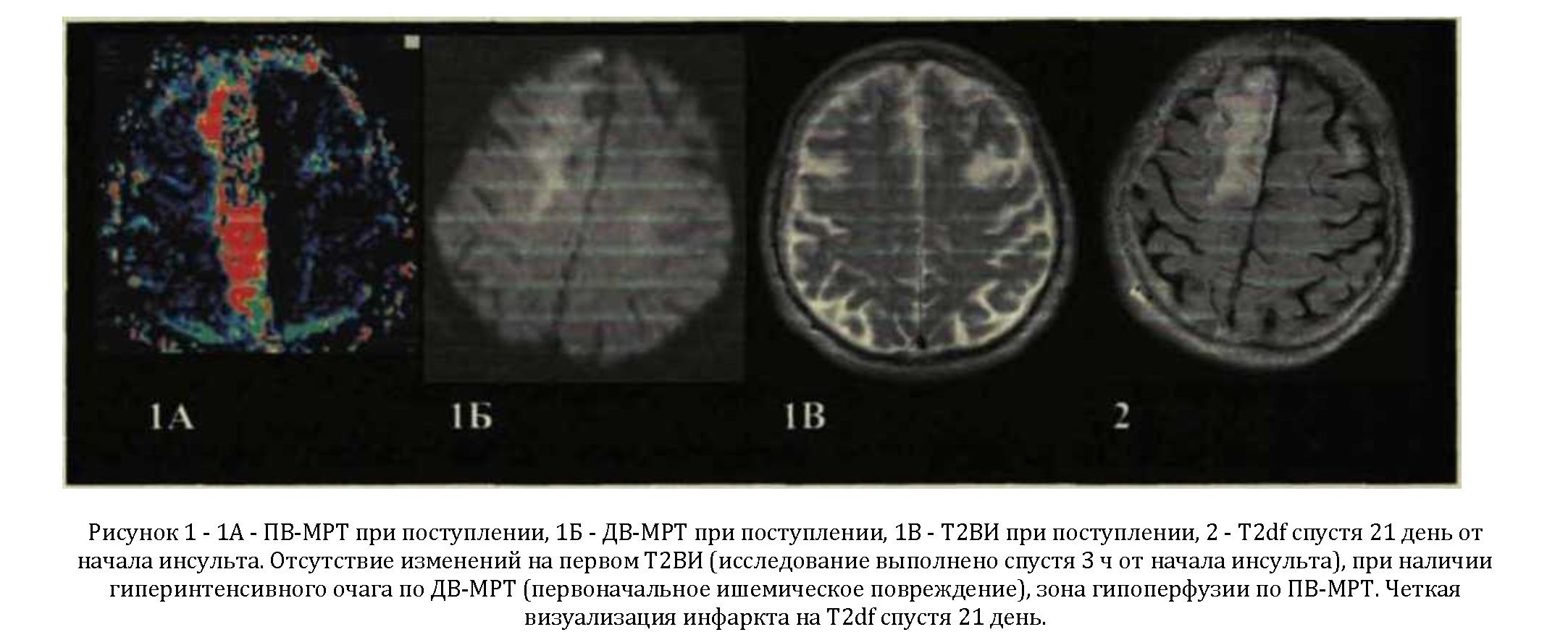 Клинико-нейровизуализационная картина ишемического инсульта в остром периоде