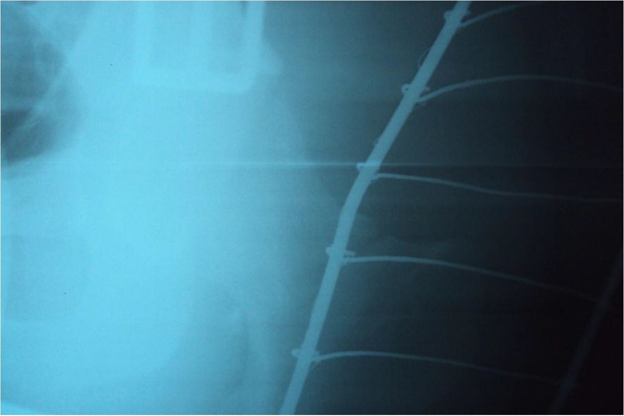 Случай оперативного лечения патологического (стрессового) перелома шейки бедренной кости