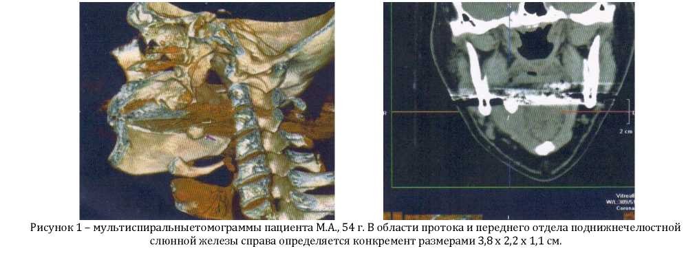 Паренхима слюнной железы