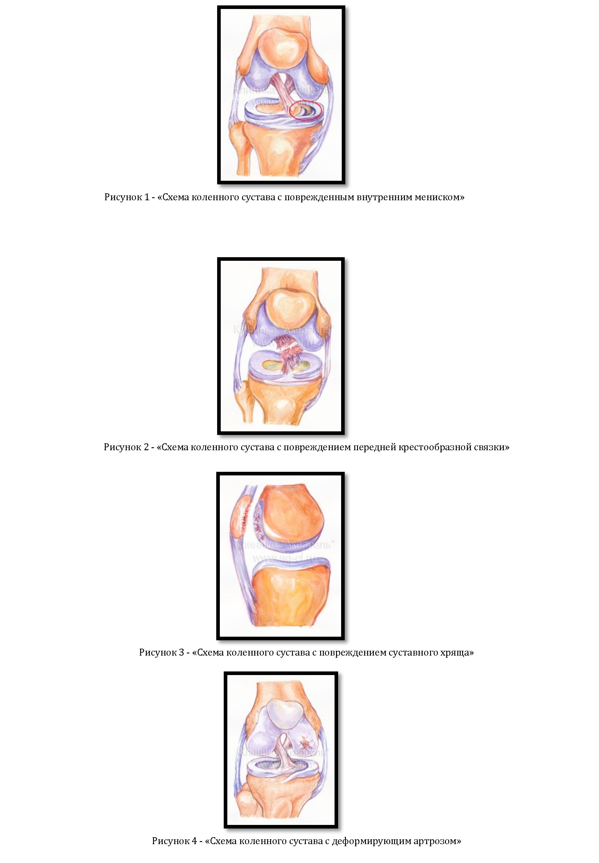 Артроскопия коленного сустава при травмах