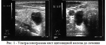 Склеротерапия доброкачественных узловых образований щитовидной железы препаратом этоксисклерол