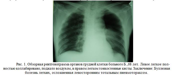 . Обзорная рентгенограмма органов грудной клетки больного Б.,68 лет. Левое легкое полностью коллабировано, поджато воздухом, в правом легком тонкостенные кисты