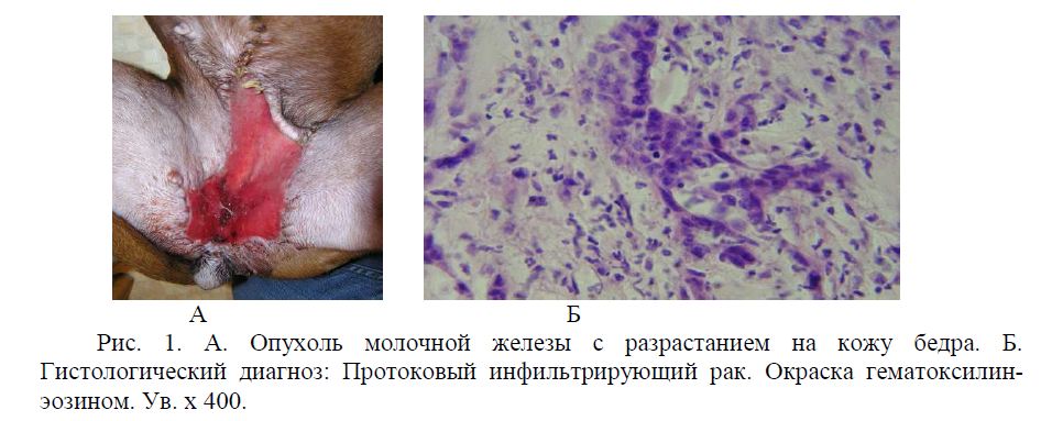 Опухоль молочной железы с разрастанием на кожу бедра. Б. Гистологический диагноз: Протоковый инфильтрирующий рак. Окраска гематоксилин- эозином. Ув. х 400.
