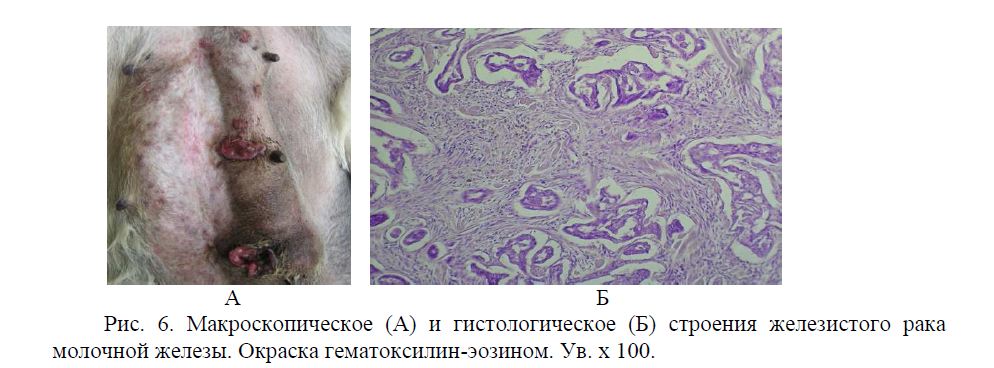 Макроскопическое (А) и гистологическое (Б) строения железистого рака молочной железы. Окраска гематоксилин-эозином. Ув. х 100.