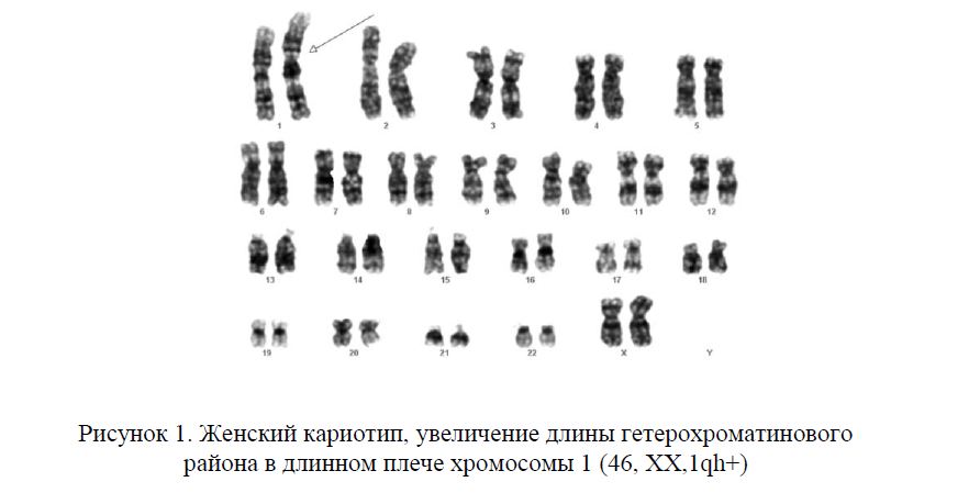 Женский кариотип, увеличение длины гетерохроматинового района в длинном плече хромосомы 1 (46, ХХ,1qh+)