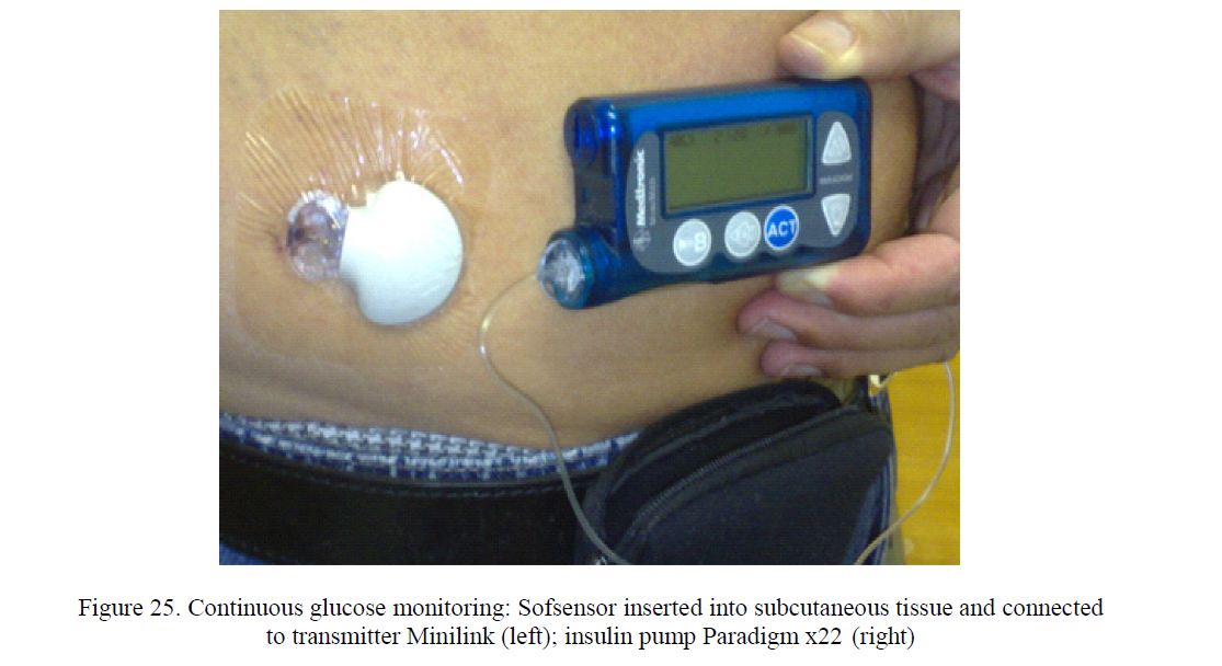 ontinuous glucose monitoring: Sofsensor inserted into subcutaneous tissue and connected to transmitter Minilink (left); insulin pump Paradigm x22 (right)