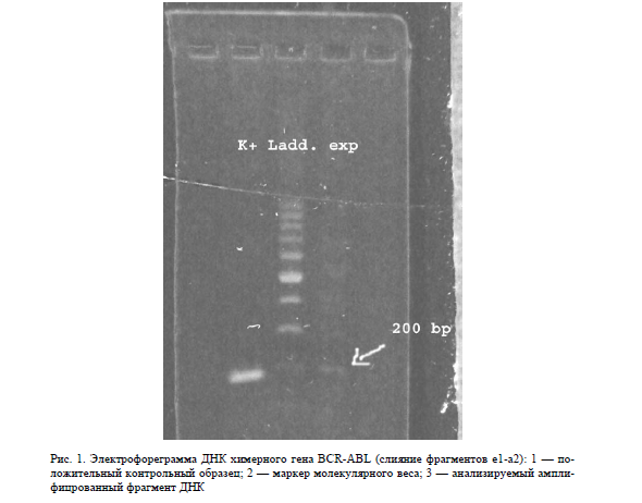  Электрофореграмма ДНК химерного гена BCR-ABL (слияние фрагментов e1-a2): 1 — положительный контрольный образец; 2 — маркер молекулярного веса; 3 — анализируемый амплифицрованный фрагмент ДНК 