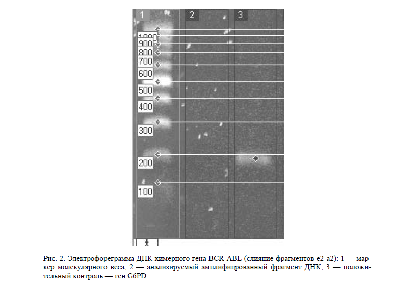 Электрофореграмма ДНК химерного гена BCR-ABL (слияние фрагментов e2-a2): 1 — маркер молекулярного веса; 2 — анализируемый амплифицрованный фрагмент ДНК; 3 — положительный контроль — ген G6PD 